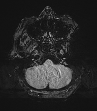 Basal ganglia metastasis (Radiopaedia 78928-91828 Axial SWI 11).png