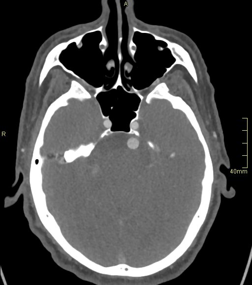 Basilar artery aneurysm (Radiopaedia 56261-62932 A 61).jpg