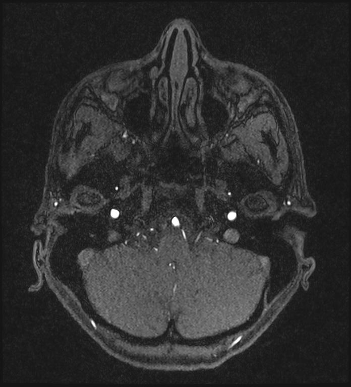 Basilar artery perforator aneurysm (Radiopaedia 82455-97733 Axial MRA 49).jpg
