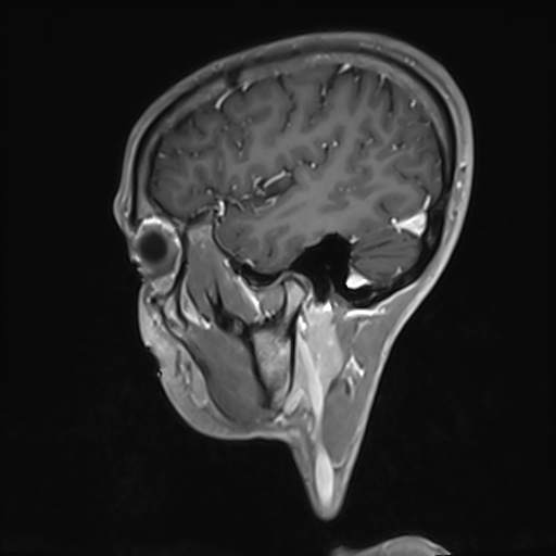 File:Basilar artery perforator aneurysm (Radiopaedia 82455-97733 G 32).jpg
