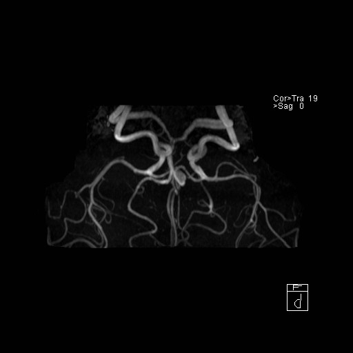 Basilar tip aneurysm (Radiopaedia 26504-26632 D 13).jpg