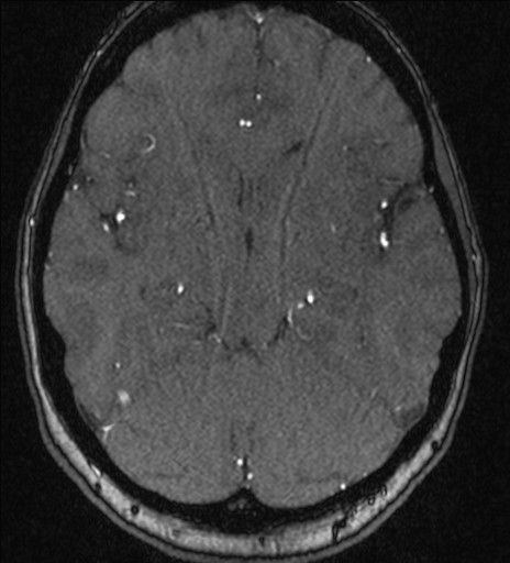 Basilar tip aneurysm (Radiopaedia 26504-26632 MRA 100).jpg