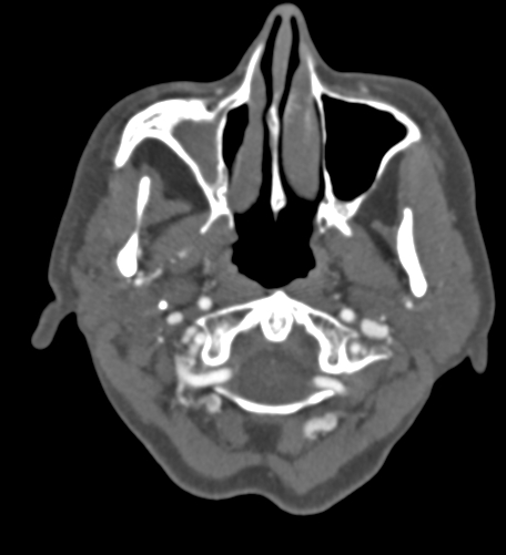File:Basilar tip aneurysm with coiling (Radiopaedia 53912-60086 A 9).jpg