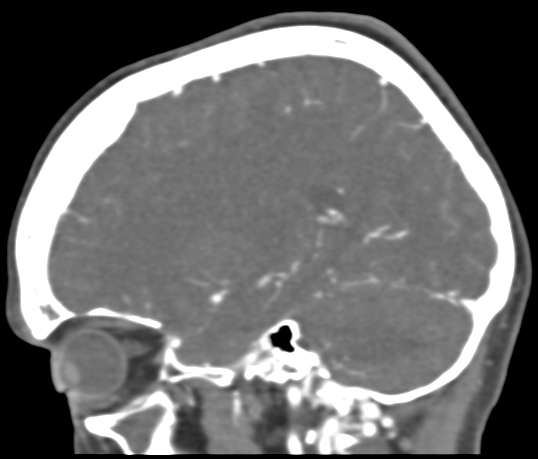 Basilar tip aneurysm with coiling (Radiopaedia 53912-60086 C 90).jpg
