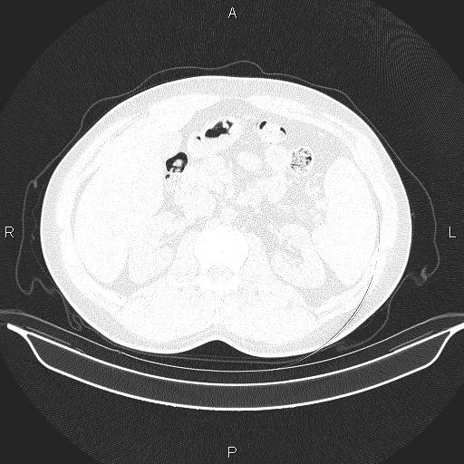 File:Beam hardening and ring artifacts (Radiopaedia 85323-100915 Axial lung window 83).jpg