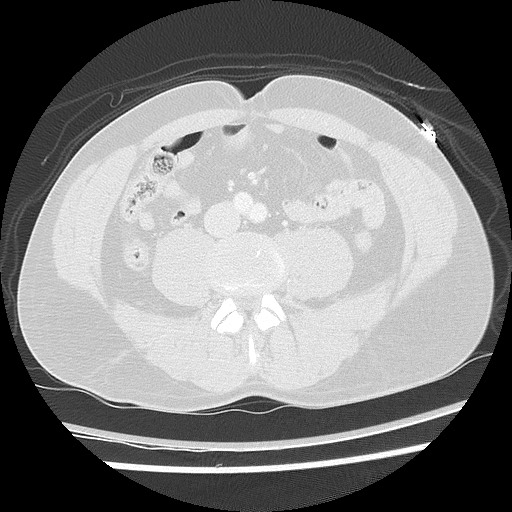 Benign post-traumatic pseudopneumoperitoneum (Radiopaedia 71199-81495 Axial lung window 100).jpg