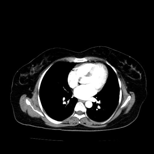 Benign spindle cell tumor - abdominopelvic (Radiopaedia 61300-69212 A 2).jpg