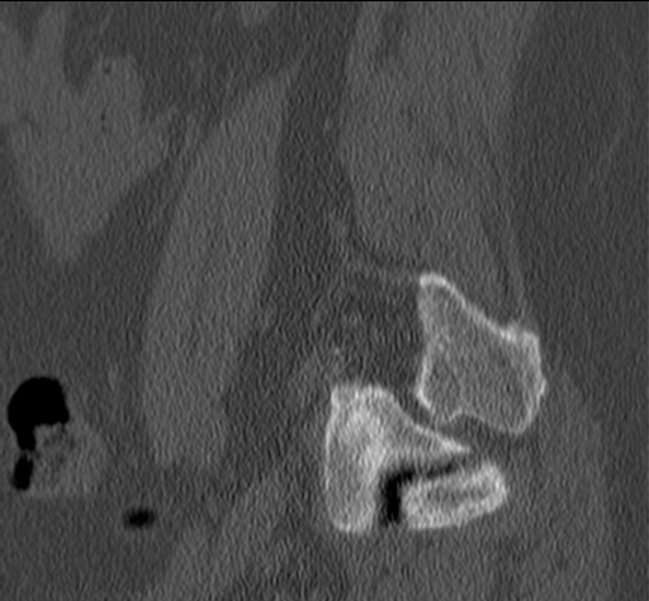 Bertolotti syndrome (Radiopaedia 24864-25128 Sagittal bone window 51).jpg