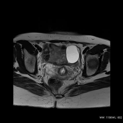 File:Bicornuate uterus- on MRI (Radiopaedia 49206-54297 Axial T2 10).jpg