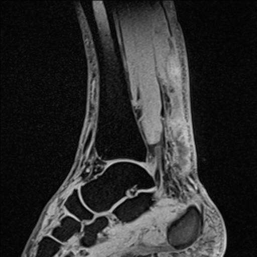 Bilateral Achilles tendon complete tear (Radiopaedia 81344-95051 Sagittal WE - Right 64).jpg
