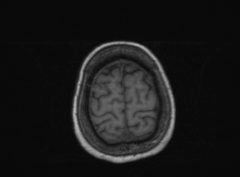 File:Bilateral PCA territory infarction - different ages (Radiopaedia 46200-51784 Axial T1 139).jpg