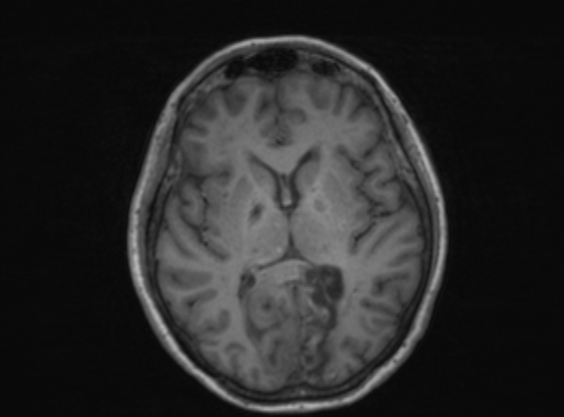 File:Bilateral PCA territory infarction - different ages (Radiopaedia 46200-51784 Axial T1 232).jpg