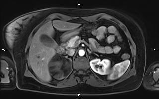 Bilateral adrenal myelolipoma (Radiopaedia 63058-71537 Axial T1 C+ fat sat 36).jpg