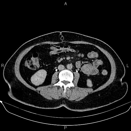 Bilateral benign adrenal adenomas (Radiopaedia 86912-103124 Axial C+ delayed 79).jpg
