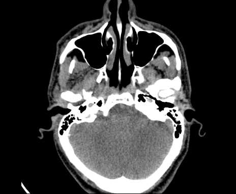 File:Bilateral carotid body tumors (Radiopaedia 61841-69870 Axial non-contrast 3).jpg