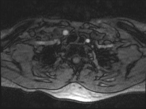 Bilateral carotid body tumors and right glomus jugulare tumor (Radiopaedia 20024-20060 Axial MRA 184).jpg