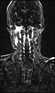 File:Bilateral carotid body tumors and right glomus jugulare tumor (Radiopaedia 20024-20060 MRA 117).jpg