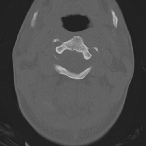Bilateral locked facets (Radiopaedia 33850-35016 Axial bone window 11).png