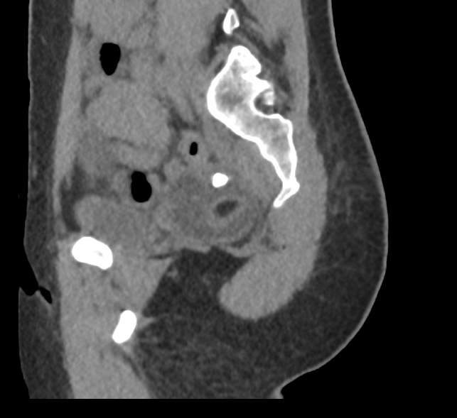 Bilateral mature cystic ovarian teratoma (Radiopaedia 88821-105592 D 50).jpg