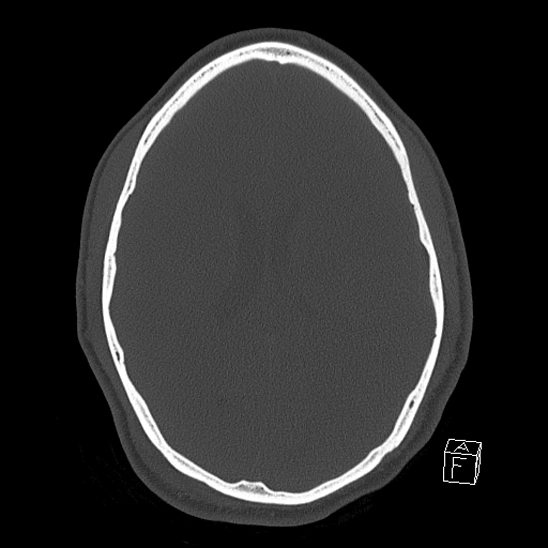 Bilateral occipital condyle fracture (type 2) (Radiopaedia 87675-104089 Axial bone window 83).jpg