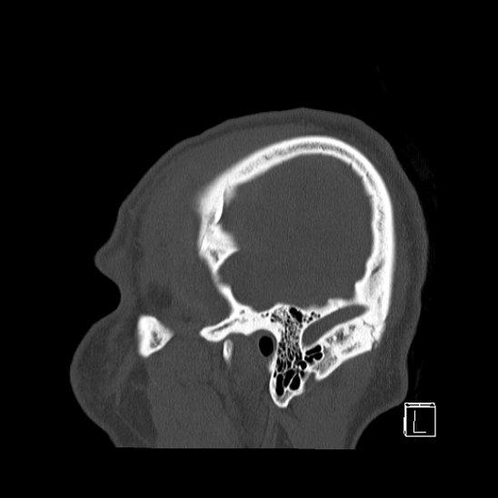 Bilateral occipital condyle fracture (type 2) (Radiopaedia 87675-104089 Sagittal bone window 107).jpg