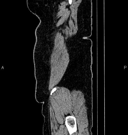 Bilateral ovarian dermoid cysts (Radiopaedia 85785-101603 D 96).jpg