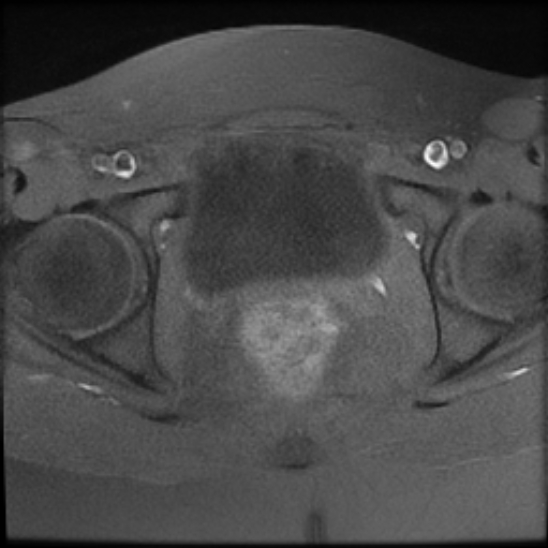 File:Bilateral ovarian fibrothecomas - adolescent (Radiopaedia 86604-102707 Axial T1 fat sat 24).jpg
