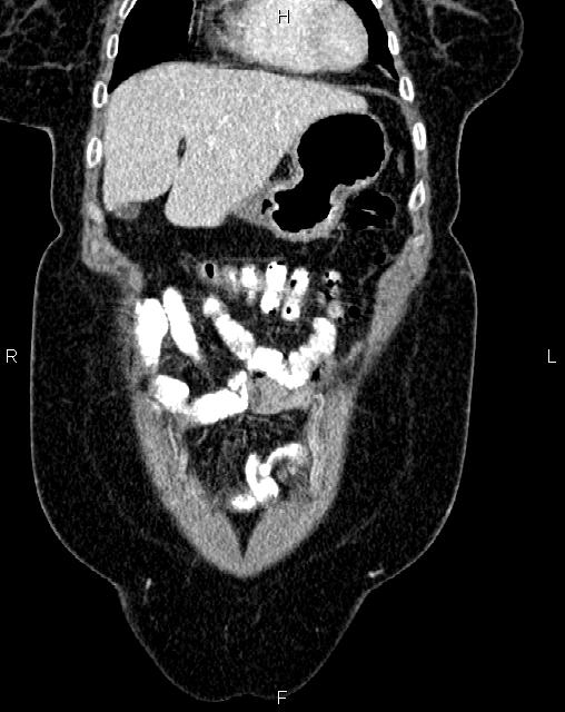 Bilateral ovarian serous cystadenocarcinoma (Radiopaedia 86062-101989 D 2).jpg
