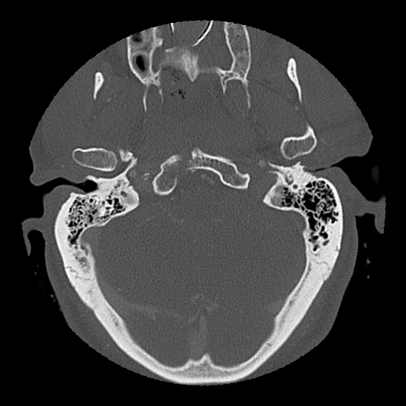 Bilateral perched facets with cord injury (Radiopaedia 45587-49713 Axial bone window 11).jpg