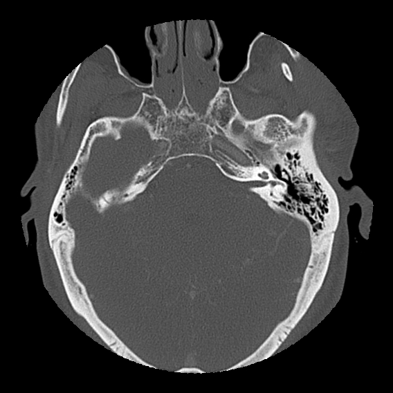 File:Bilateral perched facets with cord injury (Radiopaedia 45587-49713 Axial bone window 3).jpg