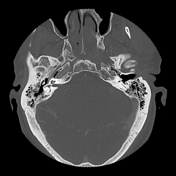 File:Bilateral perched facets with cord injury (Radiopaedia 45587-49713 Axial bone window 6).jpg