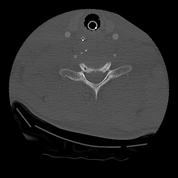 Bilateral perched facets with cord injury (Radiopaedia 45587-49713 Axial bone window 81).jpg