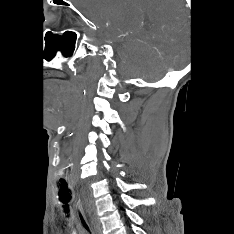 Bilateral perched facets with cord injury (Radiopaedia 45587-49713 B 31).jpg