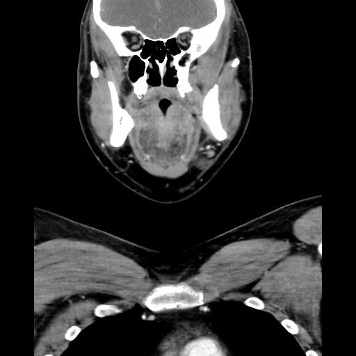 Bilateral peritonsillar abscess (Radiopaedia 85065-100610 Coronal 27).jpg