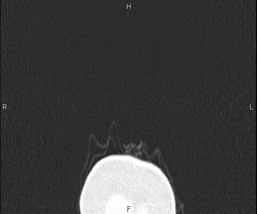 Bilateral pulmonary AVM (Radiopaedia 83134-97505 Coronal lung window 1).jpg