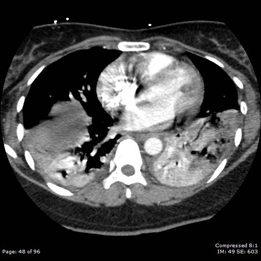 File:Bilateral pulmonary emboli with Hampton hump sign (Radiopaedia 54070-60246 Axial C+ CTPA 45).jpg