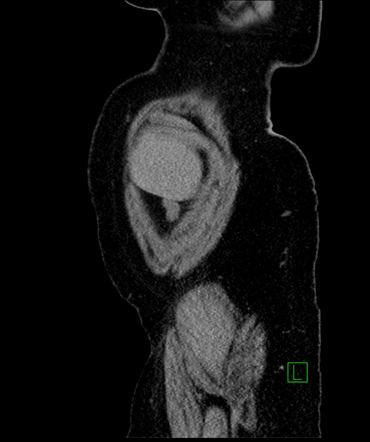 Bilateral sporadic synchronous clear cell renal cell carcinoma (Radiopaedia 85035-100575 E 113).jpg
