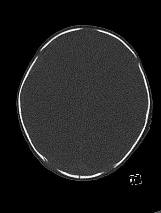 Bilateral subdural hemorrhage and parietal skull fracture (Radiopaedia 26058-26192 Axial bone window 43).png