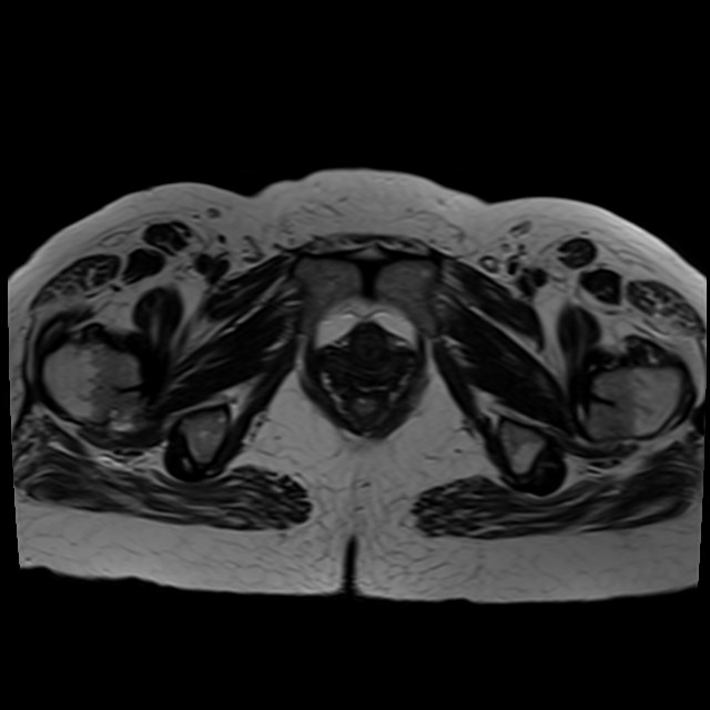 Bilateral tubo-ovarian abscesses (Radiopaedia 58635-65829 Axial T2 42).jpg