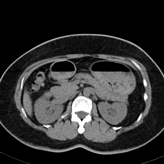 Bilateral ureteric stents (Radiopaedia 48795-53825 Axial non-contrast 20).jpg