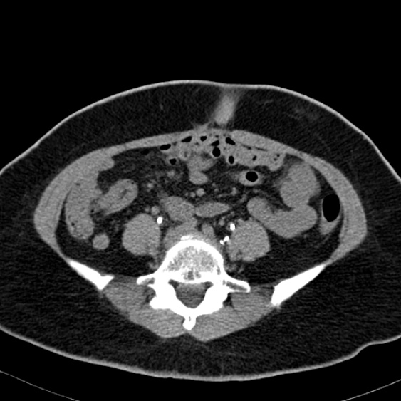 Bilateral ureteric stents (Radiopaedia 48795-53825 Axial non-contrast 39).jpg