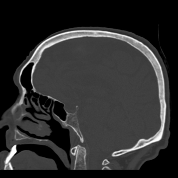 Biparietal osteodystrophy (Radiopaedia 46109-50463 Sagittal bone window 54).jpg