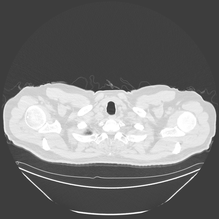 Birt-Hogg-Dubé syndrome (Radiopaedia 52578-58491 Axial lung window 1).jpg