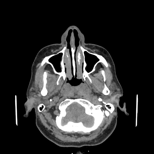 Bisphosphonate-related osteonecrosis of the jaw (Radiopaedia 71324-81642 non-contrast 131).jpg