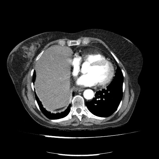 File:Bladder tumor detected on trauma CT (Radiopaedia 51809-57609 A 62).jpg