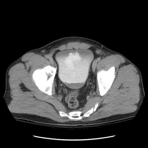 Blunt abdominal trauma with solid organ and musculoskelatal injury with active extravasation (Radiopaedia 68364-77895 Axial C+ delayed 123).jpg