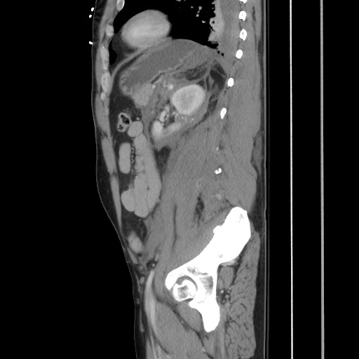 File:Blunt abdominal trauma with solid organ and musculoskelatal injury with active extravasation (Radiopaedia 68364-77895 C 101).jpg