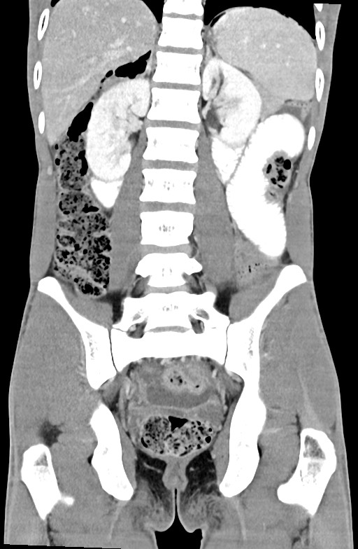 Blunt injury to the small bowel (Radiopaedia 74953-85987 B 65).jpg