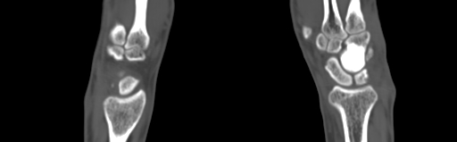 Bone islands - carpus (Radiopaedia 63141-71658 Coronal bone window 27).jpg