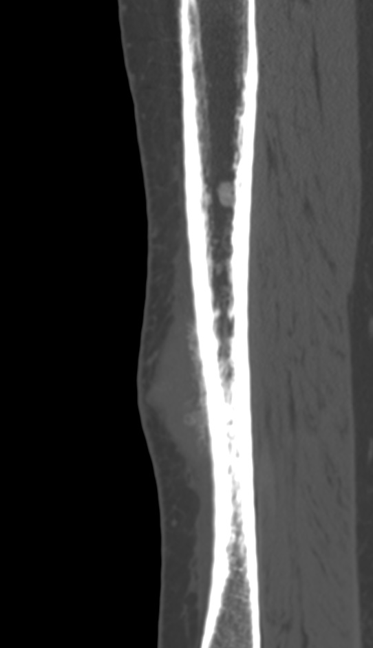 Bone metastasis - tibia (Radiopaedia 57665-64609 Sagittal bone window 57).jpg